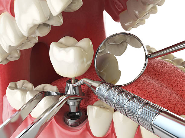 Best Emergency Tooth Extraction in Thonotosassa, FL